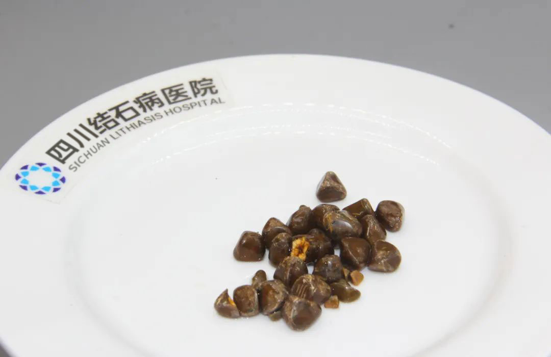 为什么得胆囊结石的人越来越多了？小心这些行为，你可能每天都在做！【四川结石病医院】(图2)